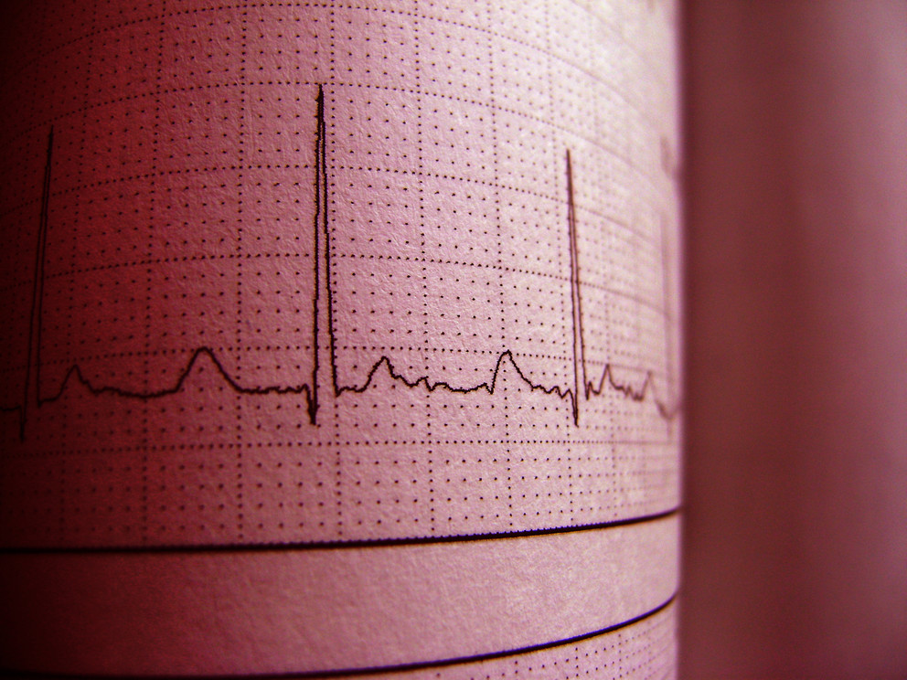 Heart data.