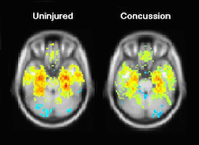 MRI scan of concussion