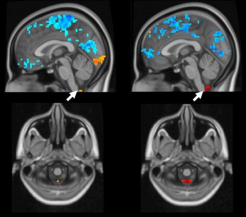 In human brains, as global brain activity (blue) occurs, the arrows point to cerebral spinal fluid moving (orange and red). In these functional MRI images, the left brain demonstrates a weaker coupling, indicating Alzheimer's disease.